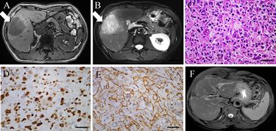 Case report: immunotherapy successfully treated brain metastasis in intrahepatic cholangiocarcinoma and literature review